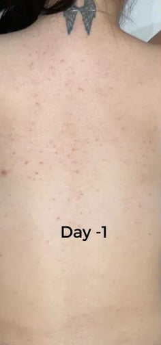 Before and after comparison of skin treatment on a person's back, labeled 'Day -1' and 'Day -40'.