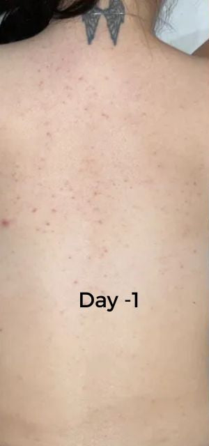 Before and after comparison of skin treatment on a person's back, labeled 'Day -1' and 'Day -40'.